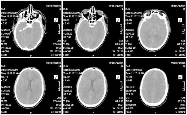 Ein Collage von MRI-Gehirnscans, die die Hirnrinde hervorheben.