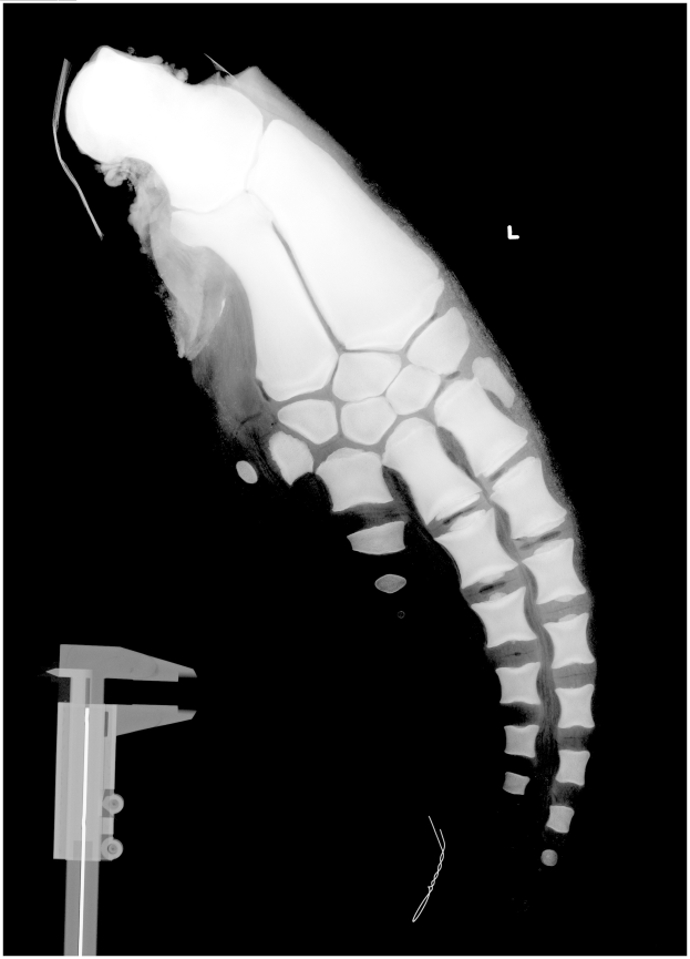 Ein Röntgenbild eines Mannes mit einem Mittelfraktur im Bein, mit einem Metallband auf der linken Seite, vor schwarzem Hintergrund.