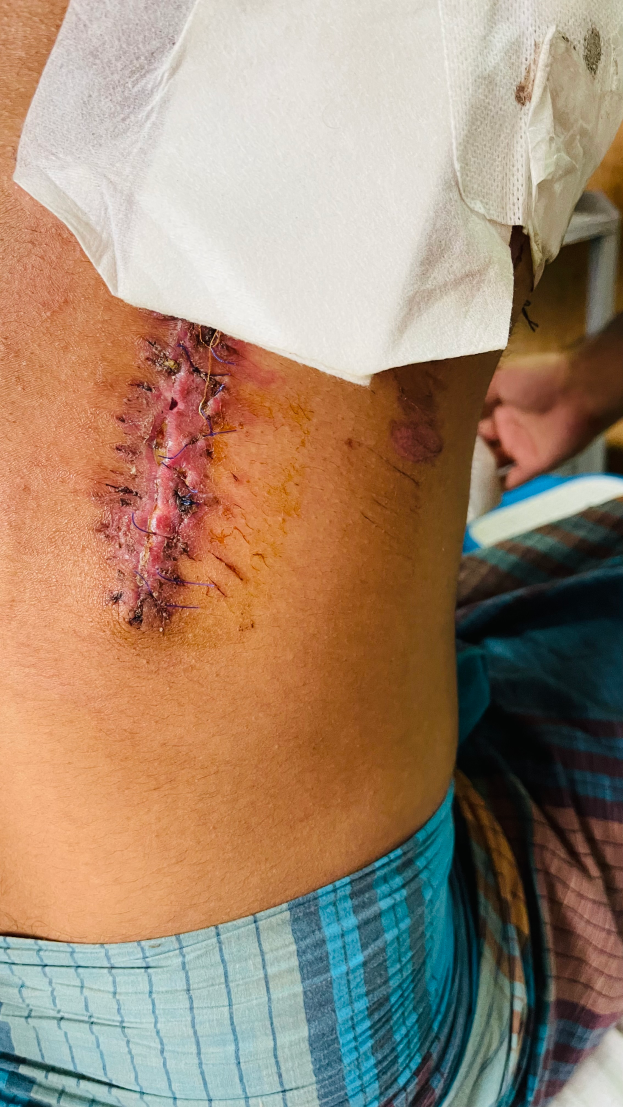 Ein Mann im Krankenhausbett mit einem verbundenen Bein und einer Narbe auf seinem Bauch, mit einer anderen Person und einem Tisch im Hintergrund.